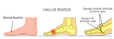 Hallux Rigidus - Stiff Big Toe Joint Treatment 