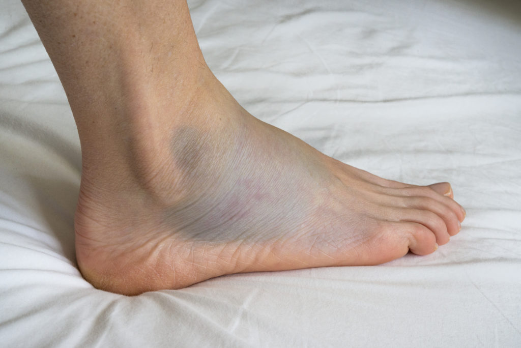 Lateral Ankle Ligament Instability