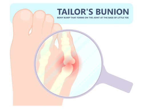 What is a Bunionette and What Should I do About it?