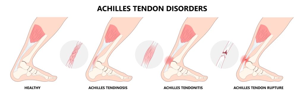 torn tendons do not always require surgery