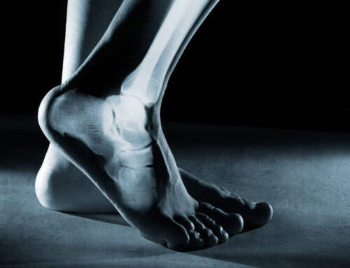 Sprained Ankle vs Broken Ankle: What’s the Difference?