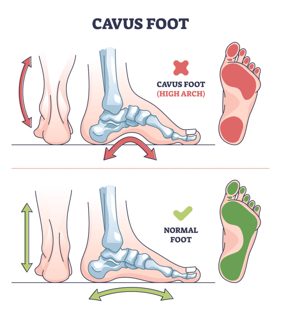 Cavus foot reconstruction in Boise