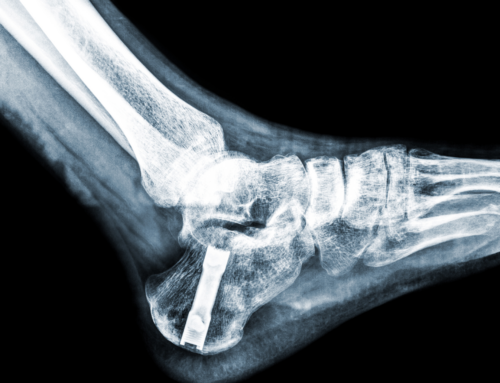 Life After a Calcaneus Fracture: Steps to Recovery