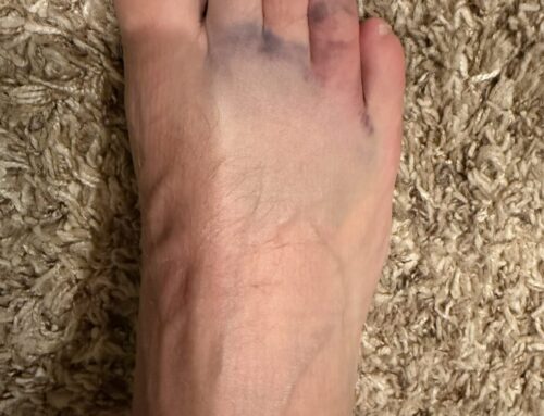 Small Toe Fractures