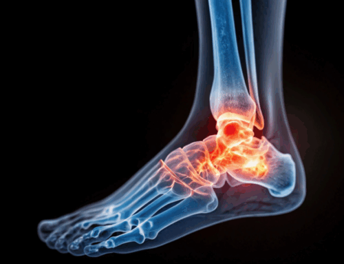 Ankle Sprains That Keep Coming Back: What Might Be Going On