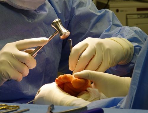 Is Your Bunion Getting Worse? How to Know When It’s Time to See a Surgeon